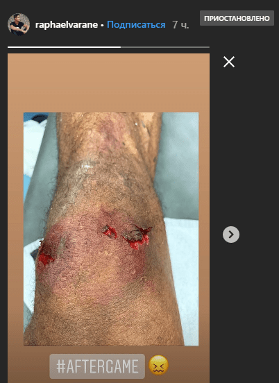 Как выглядит «раздробленое» колено игрока «Реала» после автогола в игре с «Барсой»